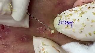 Loan Nguyen Acne Treatment 16388 [upl. by Lilyan88]