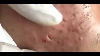 Blackheads  Best of 2018 Spreading comedones  Senile Blackheads [upl. by Ayalahs]