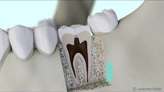 Protocole de dévitalisation dune dent ou traitement endodontique [upl. by Anali]