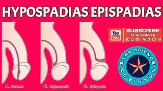 HYPOSPADIAS EPISPADIAS IN STAR SCIENCE ROBINSON [upl. by Adaval]