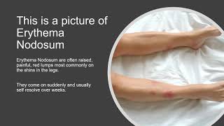 Erythema Nodosum  Brief Review and Photo [upl. by Ijnek863]