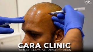 CARA Hair Transplant  Home of Innovative Hair Restoration [upl. by Nolham81]