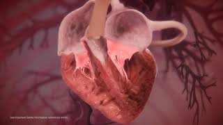 MitraClip Procedure Animation Video [upl. by Chancellor]