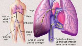 Pulmonary Embolism [upl. by Hadrian]