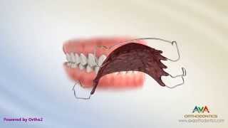 Orthodontic Retainers Hawley Clear and Permanent [upl. by Rozamond513]