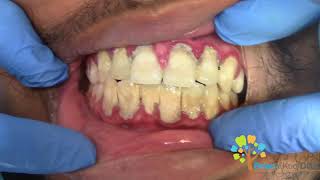 Dental Cleaning to remove heavy tartar🦷 【Young Male first cleaning】 [upl. by Airdnax]