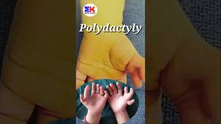 Polydactyly  What is Polydactyly shorts MedicineKnowledgehindi [upl. by Clorinde55]