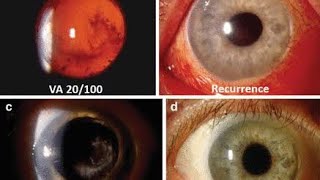 Endophthalmitis Diagnosis Clinical Approach [upl. by Flanigan52]