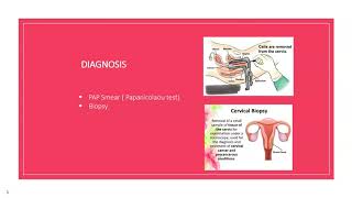 Chronic Cervicitis by Nadia Naseem [upl. by Eilyac]