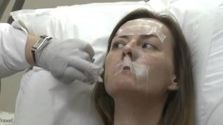 Cosmetic Treatments Real Life Example  Dermal Fillers Dr Nick Lowe [upl. by Anawed]