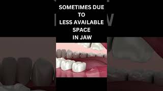 WISDOM TOOTH ERUPTION bestdentalclinic dentist bestcosmeticdentalclinic dentalclinic dental [upl. by Ailemrac592]