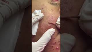 Best Pimple Popping 07 beautiful blackheads sacdepspa [upl. by Yanarp]