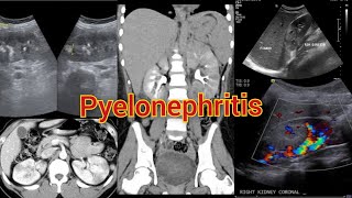 Radiology Viva Case  05  Pyelonephritis Complicated by Pseudoaneurysm medical radiology doppler [upl. by Beutler]