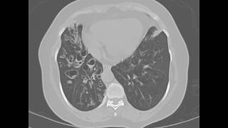 Cystic bronchiectasis  axial lung ct [upl. by Ahsihat]