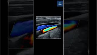 Carotid Doppler Understanding its Importance in Vascular Health [upl. by Amehsyt919]