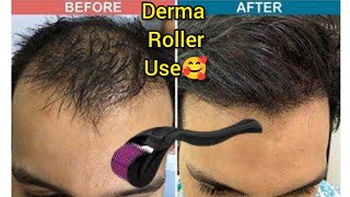 How Many Times Derma Roller can be used  Derma Roller Hair Regrowth  Microneedle At Home [upl. by Casavant243]