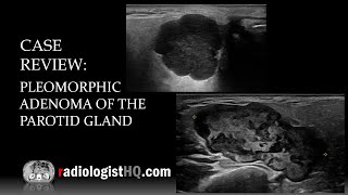 Ultrasound of Pleomorphic Adenoma of the Parotid Gland [upl. by Auehsoj]