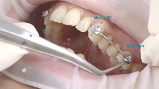 Carriere® Motion™ Class II Appliance Placement Video [upl. by Bohaty]