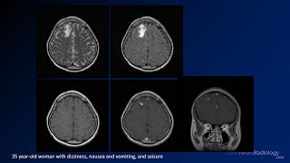 Intracranial infections  5  Other [upl. by Demetre]