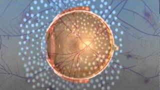 Vitrectomy Surgery for Diabetic Retinopathy [upl. by Kinna]