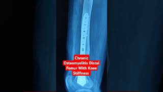 Chronic Osteomyelitis Distal Femur With Knee Stiffness Dr Sai Chandra [upl. by Higgins]