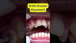 Braces Installation REVEALED Step by Step [upl. by Downey584]