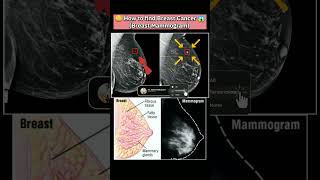 🤔How to find Breast Cancer😱 cancer breastcancer xray youtubeshorts mammogram disease medical [upl. by Ahterod]