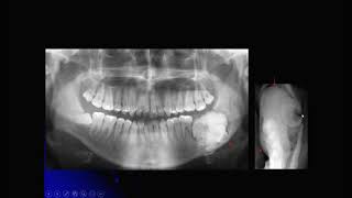 Aula de Cistos e Tumores Odontogênicos [upl. by Ellekram]