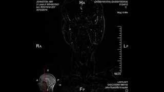 My MRI Angiogram Carotid [upl. by Akirret938]