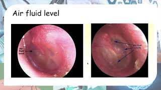 Acute otitis media  Otoscopy findings [upl. by Keavy]