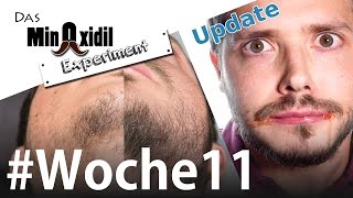 Vorher Nachher Allergieupdate und Schattenseiten  Das Minoxidil Experiment Woche11 [upl. by Leidba]