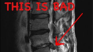 How to Read a Spine MRI [upl. by Estelle]