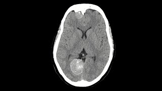 Falx meningioma MRI brain [upl. by Derdle]