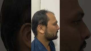 Hair Transplantation by Experts  shorts  Hair Transplantation Procedure results haircare [upl. by Sabba587]