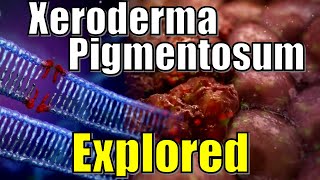 quot Vampire Syndrome quot Xeroderma Pigmentosum DNA Damaged Explained  Effects of UV Radiation on Genes [upl. by Neeruam]