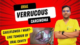 Dr Rudra Mohan  Oral Verrucous CarcinomaCauliflower WartLike Tumour of the Oral Cavity  OVC [upl. by Trovillion]