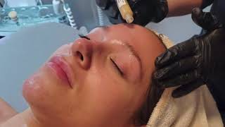 Ultraceuticals AZyme Peel Facial [upl. by Nolyak879]