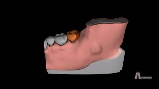 Animation  Dentigerous Cyst 3D Model [upl. by Nnael]