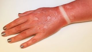 FX MAKEUP SERIES First Degree Burn Sunburn [upl. by Akyssej40]