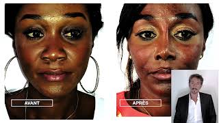 Rhinoplastie Ultrasonique  Résultat sur nez caucasien et sur nez africain [upl. by Stormi]