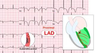 Ischemia 57 Examples of UA and NSTEMI [upl. by Christophe]