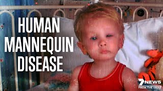 Worlds Rarest Disease The Human Mannequin  Documentary [upl. by Rosenstein]