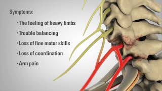 Cervical Laminectomy  Patient Animation [upl. by Nahpets155]