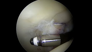 Articular Cartilage with a Grade 3 Injury to the Posterior Acetabulum near full thickness [upl. by Bil]