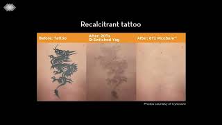 PicoSure Laser Tattoo Removal [upl. by Lasiaf]