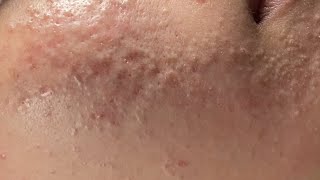 Acne Treatment Huong Da Nang  2024 acne608 [upl. by Cyril]