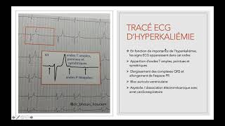 Flash ECG  Hyperkaliémie [upl. by Madelle144]