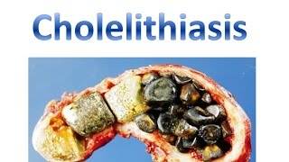 Cholelithiasis [upl. by Eatnuahc51]