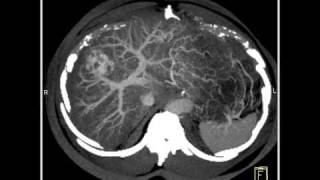 Abdomen LiverCT demonstrates a hemangioma of the liver because of the fatty infiltration10 of 10 [upl. by Morlee]