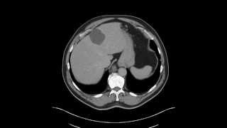 Esophagus  Leiomyoma distal esophagus [upl. by Lacym176]